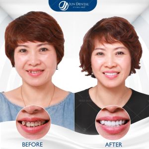 Hình ảnh bọc răng sứ - Nha khoa Thẩm mỹ Quốc tế Jun Dental – Ca 4