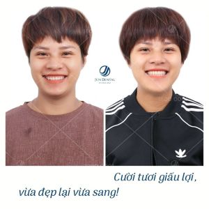 Hình ảnh điều trị cười hở lợi – Nha khoa Thẩm mỹ Quốc tế Jun Dental – Ca 5
