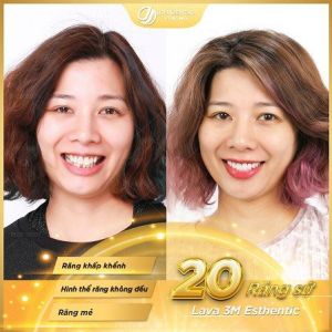 Hình ảnh bọc răng sứ của KH Mai – Nha khoa Thẩm mỹ Quốc tế Jun Dental – Ca 6