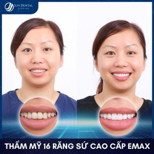 Hình ảnh bọc răng sứ của KH Hà – Nha khoa Thẩm mỹ Quốc tế Jun Dental – Ca 7