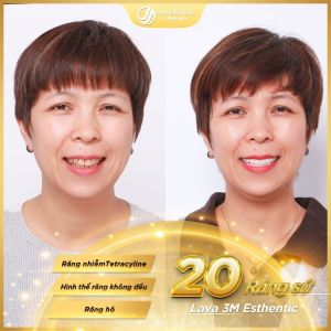 Hình ảnh bọc răng sứ của KH Nhàn – Nha khoa Thẩm mỹ Quốc tế Jun Dental – Ca 8