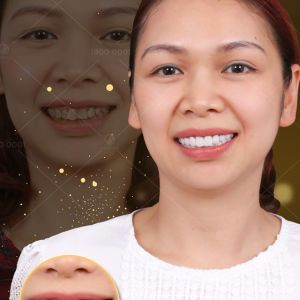 Hình ảnh bọc răng sứ - Nha khoa Thẩm mỹ Quốc tế Jun Dental – ca 9