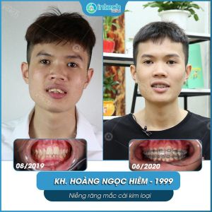 Hình ảnh niềng răng thành công của KH Hoàng Ngọc Hiêm – Ca 01
