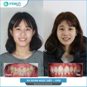 Hình ảnh niềng răng mắc cài kim loại của KH Đoàn Ngọc Diệp – Ca 02
