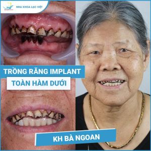 Hình ảnh trồng răng implant của KH bà Ngoan – Ca 03