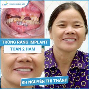 Hình ảnh trồng răng implant của KH Nguyễn Thị Thảnh – Ca 04