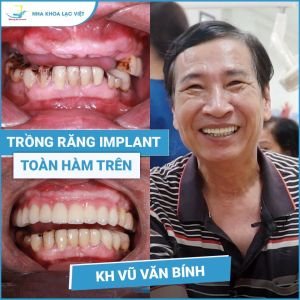 Hình ảnh trồng răng implant của KH Vũ Văn Bính – Ca 05
