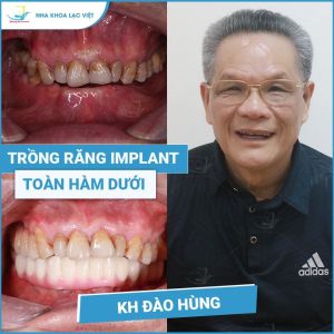 Hình ảnh trồng răng implant của KH Đào Hùng - Ca 06
