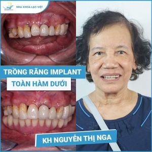 Hình ảnh trồng răng implant của KH Nguyễn Thị Nga – Ca 07