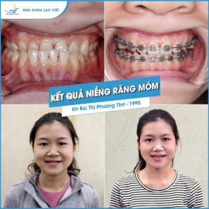 Hình ảnh niềng răng của KH Bùi Thị Phương Thơ – Ca 08