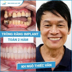 Hình ảnh trồng răng implant của KH Ngô Thiếc Văn – Ca 09
