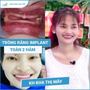 Hình ảnh trồng răng implant của KH Kha Thị Mây – Ca 10