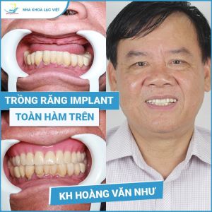 Hình ảnh trồng răng implant của KH Hoàng Văn Như – Ca 11