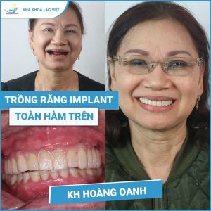 Hình ảnh trồng răng implant của KH Hoàng Oanh – Ca 12