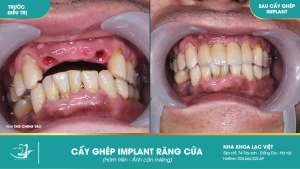 Hình ảnh cấy ghép implant răng cửa của KH Tag Ching Yao – Ca 13