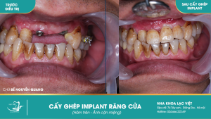 Hình ảnh trồng răng implant của KH Bế Nguyễn Quang – Ca 14