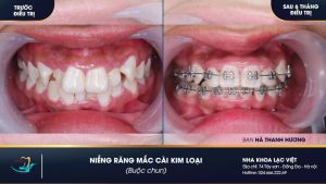 Hình ảnh niềng răng mắc cài kim loại của KH Hà Thanh Hương – Ca 15