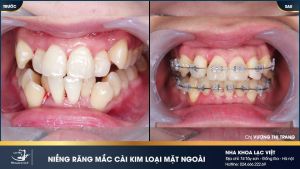 Hình ảnh niềng răng mắc cài kim loại của KH Vương Thị Trang – Ca 16