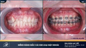Hình ảnh niềng răng mắc cài kim loại của KH Nguyễn Thị Hiền – Ca 17