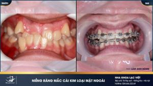 Hình ảnh niềng răng mắc cài kim loại của KH Lâm Anh Dũng – Ca 18