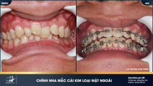Hình ảnh niềng răng mắc cài kim loại của KH Trương Xuân Thắng – Ca 19