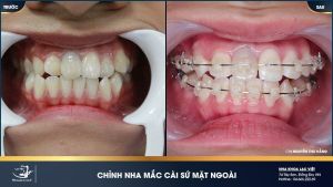 Hình ảnh niềng răng mắc cài sứ của KH Nguyễn Thu Hằng – Ca 20
