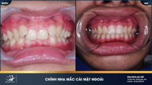 Hình ảnh niềng răng mắc cài mặt ngoài của anh Sơn – Ca 21