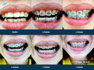 Hình ảnh niềng răng của KH Tố Nga – Ca 22