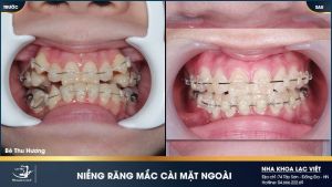 Hình ảnh niềng răng mắc cài sứ của KH Thu Hương – Ca 23