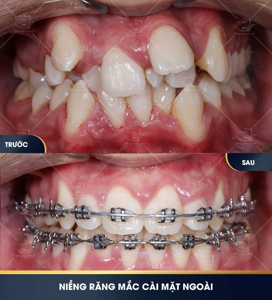Loạt ảnh trước và sau khi niềng răng khiến bạn phải ngỡ ngàng