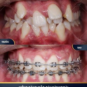 Hình ảnh niềng răng mắc cài của KH Anh Phong – Ca 24