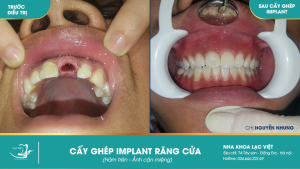 Hình ảnh trồng răng implant của KH Nguyễn Nhung – Ca 25