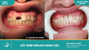 Hình ảnh trồng răng implant của KH Nguyễn Văn Thanh – Ca 26