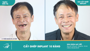 Hình ảnh trồng răng implant của KH Trần Quang Hà – Ca 27
