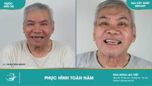 Hình ảnh phục hình toàn hàm của KH Hoàng Đình Quang – Ca 28