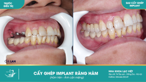 Hình ảnh trồng răng implant của KH chị Lan – Ca 29