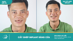 Hình ảnh trồng răng implant của KH Vũ Quang Vinh – Ca 30