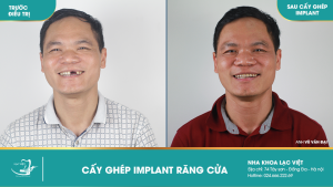 Hình ảnh cấy ghép implant của KH Vũ Văn Đại – Ca 31