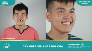 Hình ảnh trồng răng implant của KH Nguyễn Quang Duy – Ca 32