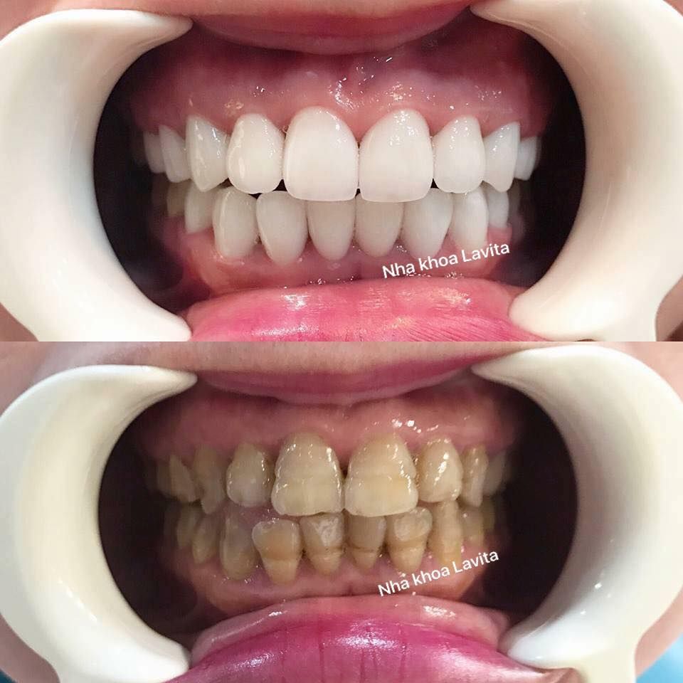 Hình ảnh bọc 10 răng sứ - Ca 10