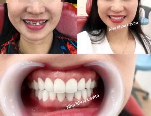 Hình ảnh bọc răng sứ - Ca 11