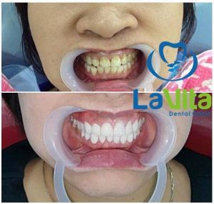 Hình ảnh bọc răng sứ - Ca 13
