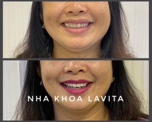 Hình ảnh bọc răng sứ - Ca 2