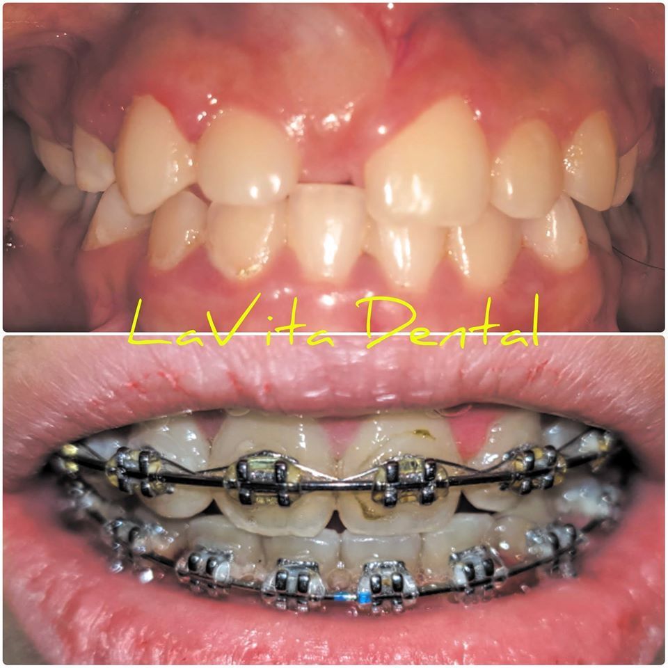 Hình ảnh niềng răng TH mọc răng ngầm – Ca 3
