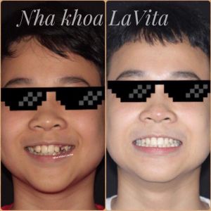 Hình ảnh niềng răng – Ca 7