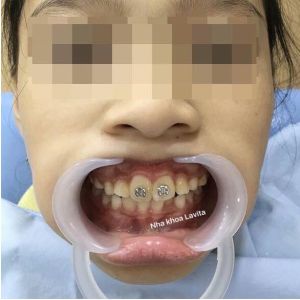 Hình ảnh niềng răng – Ca 8