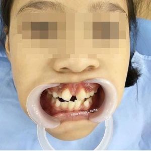 Hình ảnh niềng răng – Ca 8