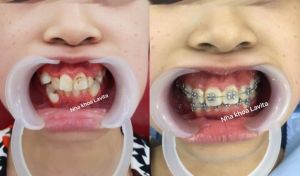 Hình ảnh niềng răng – Ca 9