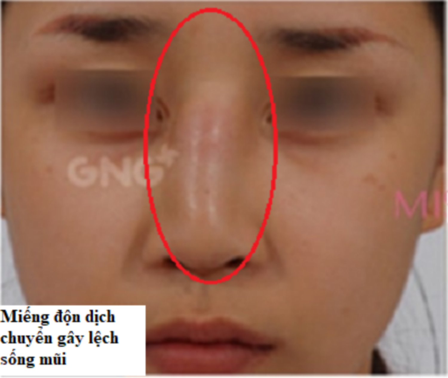miêng độn dịch chuyển