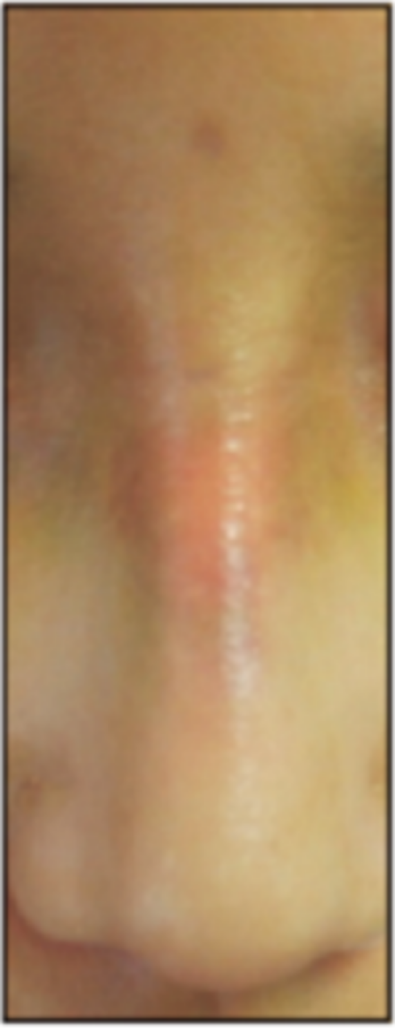 miếng độn goretex được nhìn thấy qua da sau 4 ngày phẫu thuật